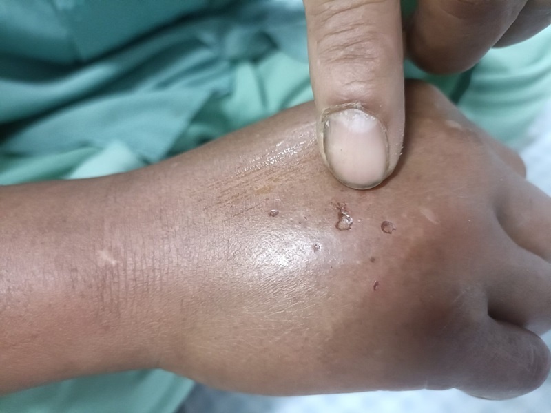 Xử lý khi bị rắn cắn